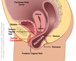 Rectocele, Intimtornához Biofeedback Gátizom tréner, enterococcus sp okozta húgyúti gyulladás, Escherichia coli baktériumok okozta fertőzés, inkontinencia, hólyaghurut,